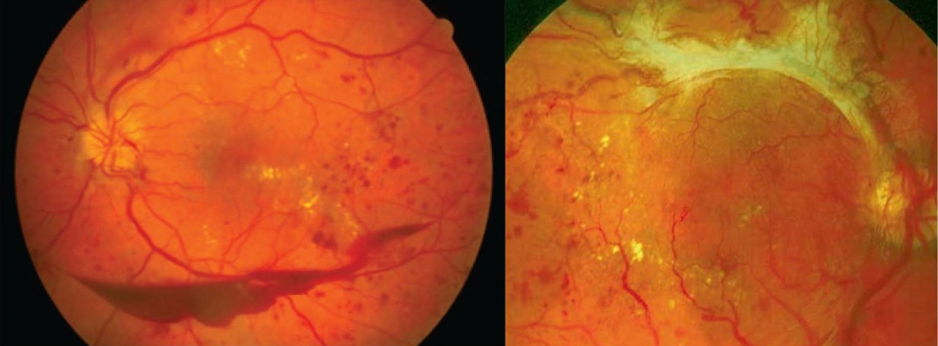 Retina