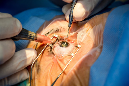 Cataract